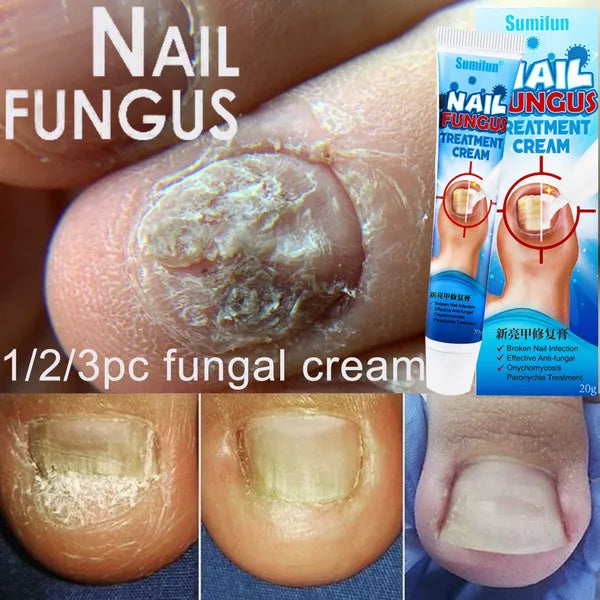 Crema de Cuidados Intensivos para Hongos